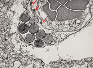 M,71y. | CADASIL accompanied with Alzheimer disease - brain vessel - arrows: granular osmiophilic material (GOM) between basement membranes M,71y. | CADASIL accompanied with Alzheimer disease - brain vessel - arrows: granular osmiophilic material (GOM) between basement membranes
